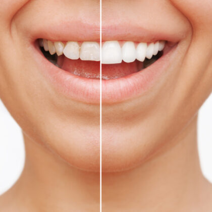 demonstrate the difference in a smile with and without veneers